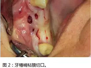 上頜竇瘺修補(bǔ)術(shù)——改良式旋轉(zhuǎn)帶蒂粘膜瓣修補(bǔ)術(shù)的應(yīng)用 上頜竇瘺修補(bǔ)術(shù)——改良式旋轉(zhuǎn)帶蒂粘膜瓣修補(bǔ)術(shù)的應(yīng)用