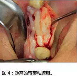 上頜竇瘺修補(bǔ)術(shù)——改良式旋轉(zhuǎn)帶蒂粘膜瓣修補(bǔ)術(shù)的應(yīng)用 上頜竇瘺修補(bǔ)術(shù)——改良式旋轉(zhuǎn)帶蒂粘膜瓣修補(bǔ)術(shù)的應(yīng)用