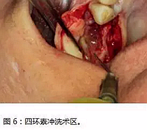 上頜竇瘺修補(bǔ)術(shù)——改良式旋轉(zhuǎn)帶蒂粘膜瓣修補(bǔ)術(shù)的應(yīng)用 上頜竇瘺修補(bǔ)術(shù)——改良式旋轉(zhuǎn)帶蒂粘膜瓣修補(bǔ)術(shù)的應(yīng)用