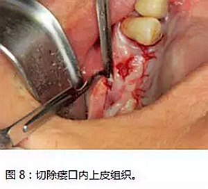 上頜竇瘺修補(bǔ)術(shù)——改良式旋轉(zhuǎn)帶蒂粘膜瓣修補(bǔ)術(shù)的應(yīng)用 上頜竇瘺修補(bǔ)術(shù)——改良式旋轉(zhuǎn)帶蒂粘膜瓣修補(bǔ)術(shù)的應(yīng)用