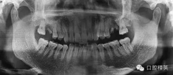 種植手術(shù)臨床與曲面斷層綜合判斷失敗病例的思與考 種植手術(shù)臨床與曲面斷層綜合判斷失敗病例的思與考