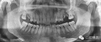 種植手術(shù)臨床與曲面斷層綜合判斷失敗病例的思與考 種植手術(shù)臨床與曲面斷層綜合判斷失敗病例的思與考