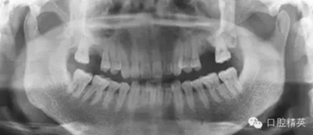 種植手術(shù)臨床與曲面斷層綜合判斷失敗病例的思與考 種植手術(shù)臨床與曲面斷層綜合判斷失敗病例的思與考