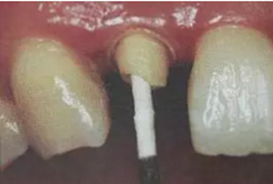 纖維樁修復(fù)之精細(xì)操作 纖維樁修復(fù)之精細(xì)操作