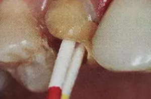 纖維樁修復(fù)之精細(xì)操作 纖維樁修復(fù)之精細(xì)操作