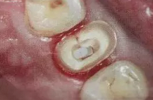 纖維樁修復(fù)之精細(xì)操作 纖維樁修復(fù)之精細(xì)操作