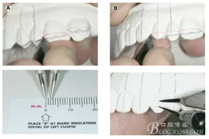 【原創(chuàng)博客】淺談間接粘托槽托槽的方法與技巧 【原創(chuàng)博客】淺談間接粘托槽托槽的方法與技巧