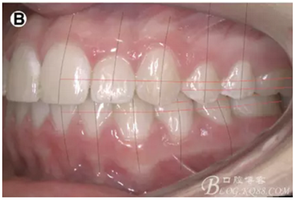 【原創(chuàng)博客】淺談間接粘托槽托槽的方法與技巧 【原創(chuàng)博客】淺談間接粘托槽托槽的方法與技巧