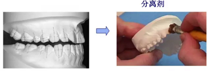【原創(chuàng)博客】淺談間接粘托槽托槽的方法與技巧 【原創(chuàng)博客】淺談間接粘托槽托槽的方法與技巧