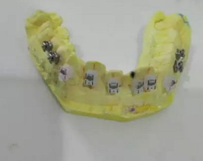 【原創(chuàng)博客】淺談間接粘托槽托槽的方法與技巧 【原創(chuàng)博客】淺談間接粘托槽托槽的方法與技巧