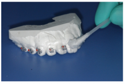 【原創(chuàng)博客】淺談間接粘托槽托槽的方法與技巧 【原創(chuàng)博客】淺談間接粘托槽托槽的方法與技巧