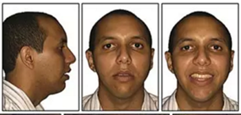 文獻優(yōu)秀正畸病例賞析-通過微種植釘及多曲方絲技術(shù)壓低下頜磨牙非手術(shù)矯治嚴重前牙開合患者1例 文獻優(yōu)秀正畸病例賞析-通過微種植釘及多曲方絲技術(shù)壓低下頜磨牙非手術(shù)矯治嚴重前牙開合患者1例