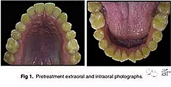 文獻優(yōu)秀正畸病例賞析-通過微種植釘及多曲方絲技術(shù)壓低下頜磨牙非手術(shù)矯治嚴重前牙開合患者1例 文獻優(yōu)秀正畸病例賞析-通過微種植釘及多曲方絲技術(shù)壓低下頜磨牙非手術(shù)矯治嚴重前牙開合患者1例