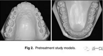 文獻優(yōu)秀正畸病例賞析-通過微種植釘及多曲方絲技術(shù)壓低下頜磨牙非手術(shù)矯治嚴重前牙開合患者1例 文獻優(yōu)秀正畸病例賞析-通過微種植釘及多曲方絲技術(shù)壓低下頜磨牙非手術(shù)矯治嚴重前牙開合患者1例