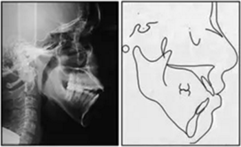 文獻優(yōu)秀正畸病例賞析-通過微種植釘及多曲方絲技術(shù)壓低下頜磨牙非手術(shù)矯治嚴重前牙開合患者1例 文獻優(yōu)秀正畸病例賞析-通過微種植釘及多曲方絲技術(shù)壓低下頜磨牙非手術(shù)矯治嚴重前牙開合患者1例