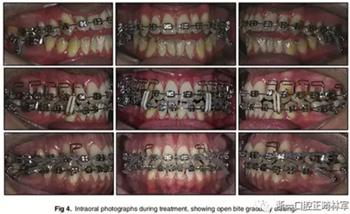 文獻優(yōu)秀正畸病例賞析-通過微種植釘及多曲方絲技術(shù)壓低下頜磨牙非手術(shù)矯治嚴重前牙開合患者1例 文獻優(yōu)秀正畸病例賞析-通過微種植釘及多曲方絲技術(shù)壓低下頜磨牙非手術(shù)矯治嚴重前牙開合患者1例