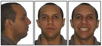 文獻優(yōu)秀正畸病例賞析-通過微種植釘及多曲方絲技術(shù)壓低下頜磨牙非手術(shù)矯治嚴重前牙開合患者1例 文獻優(yōu)秀正畸病例賞析-通過微種植釘及多曲方絲技術(shù)壓低下頜磨牙非手術(shù)矯治嚴重前牙開合患者1例