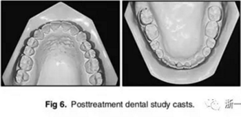 文獻優(yōu)秀正畸病例賞析-通過微種植釘及多曲方絲技術(shù)壓低下頜磨牙非手術(shù)矯治嚴重前牙開合患者1例 文獻優(yōu)秀正畸病例賞析-通過微種植釘及多曲方絲技術(shù)壓低下頜磨牙非手術(shù)矯治嚴重前牙開合患者1例