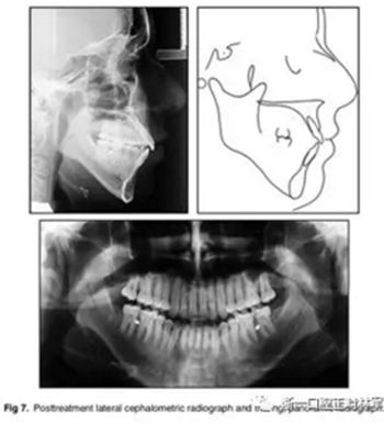 文獻優(yōu)秀正畸病例賞析-通過微種植釘及多曲方絲技術(shù)壓低下頜磨牙非手術(shù)矯治嚴重前牙開合患者1例 文獻優(yōu)秀正畸病例賞析-通過微種植釘及多曲方絲技術(shù)壓低下頜磨牙非手術(shù)矯治嚴重前牙開合患者1例
