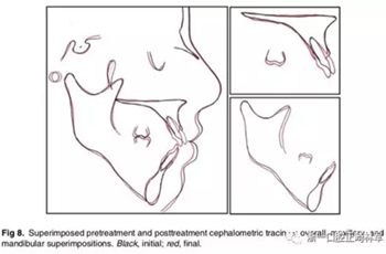 文獻優(yōu)秀正畸病例賞析-通過微種植釘及多曲方絲技術(shù)壓低下頜磨牙非手術(shù)矯治嚴重前牙開合患者1例 文獻優(yōu)秀正畸病例賞析-通過微種植釘及多曲方絲技術(shù)壓低下頜磨牙非手術(shù)矯治嚴重前牙開合患者1例