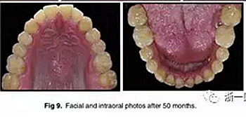 文獻優(yōu)秀正畸病例賞析-通過微種植釘及多曲方絲技術(shù)壓低下頜磨牙非手術(shù)矯治嚴重前牙開合患者1例 文獻優(yōu)秀正畸病例賞析-通過微種植釘及多曲方絲技術(shù)壓低下頜磨牙非手術(shù)矯治嚴重前牙開合患者1例