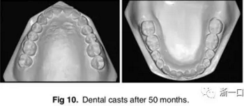 文獻優(yōu)秀正畸病例賞析-通過微種植釘及多曲方絲技術(shù)壓低下頜磨牙非手術(shù)矯治嚴重前牙開合患者1例 文獻優(yōu)秀正畸病例賞析-通過微種植釘及多曲方絲技術(shù)壓低下頜磨牙非手術(shù)矯治嚴重前牙開合患者1例