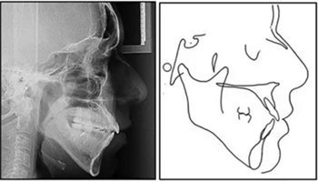 文獻優(yōu)秀正畸病例賞析-通過微種植釘及多曲方絲技術(shù)壓低下頜磨牙非手術(shù)矯治嚴重前牙開合患者1例 文獻優(yōu)秀正畸病例賞析-通過微種植釘及多曲方絲技術(shù)壓低下頜磨牙非手術(shù)矯治嚴重前牙開合患者1例