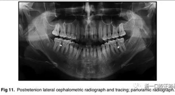 文獻優(yōu)秀正畸病例賞析-通過微種植釘及多曲方絲技術(shù)壓低下頜磨牙非手術(shù)矯治嚴重前牙開合患者1例 文獻優(yōu)秀正畸病例賞析-通過微種植釘及多曲方絲技術(shù)壓低下頜磨牙非手術(shù)矯治嚴重前牙開合患者1例