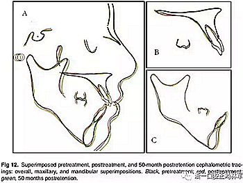 文獻優(yōu)秀正畸病例賞析-通過微種植釘及多曲方絲技術(shù)壓低下頜磨牙非手術(shù)矯治嚴重前牙開合患者1例 文獻優(yōu)秀正畸病例賞析-通過微種植釘及多曲方絲技術(shù)壓低下頜磨牙非手術(shù)矯治嚴重前牙開合患者1例