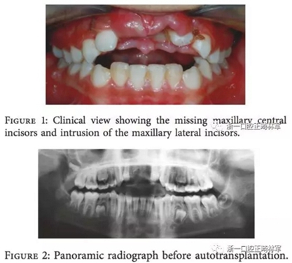 文獻(xiàn)優(yōu)秀正畸病例賞析--上頜中切牙區(qū)受傷后自體牙移植及正畸治療13年隨訪病例 文獻(xiàn)優(yōu)秀正畸病例賞析--上頜中切牙區(qū)受傷后自體牙移植及正畸治療13年隨訪病例
