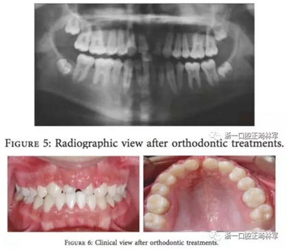 文獻(xiàn)優(yōu)秀正畸病例賞析--上頜中切牙區(qū)受傷后自體牙移植及正畸治療13年隨訪病例 文獻(xiàn)優(yōu)秀正畸病例賞析--上頜中切牙區(qū)受傷后自體牙移植及正畸治療13年隨訪病例