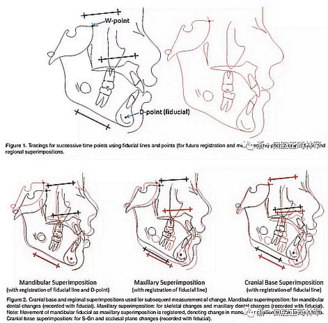 正畸文獻閱讀--不同頸椎成熟狀態(tài)使用Forsus矯治器治療II類患者的矯治效果比較