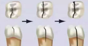 為什么有些牙齒不能拔？拔牙無(wú)小事！