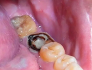 為什么有些牙齒不能拔？拔牙無(wú)小事！