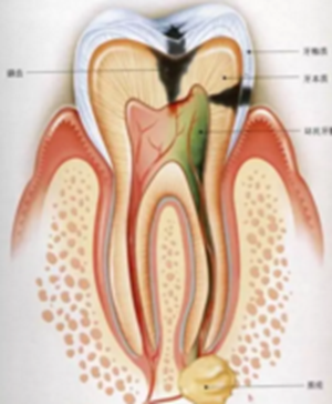為什么有些牙齒不能拔？拔牙無(wú)小事！