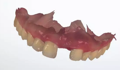 數(shù)字化修復(fù)病例分享 | 21單顆牙齒種植修復(fù) 數(shù)字化修復(fù)病例分享 | 21單顆牙齒種植修復(fù)