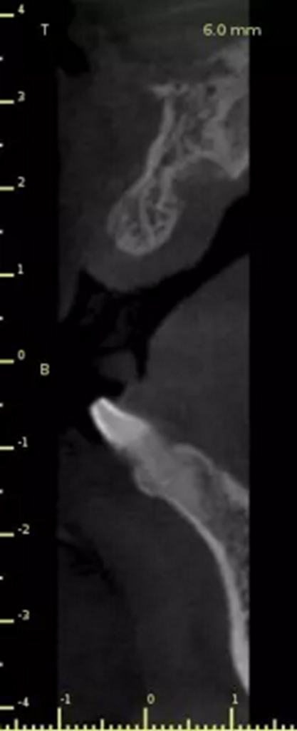 數(shù)字化修復(fù)病例分享 | 21單顆牙齒種植修復(fù) 數(shù)字化修復(fù)病例分享 | 21單顆牙齒種植修復(fù)