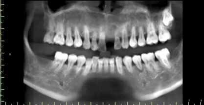 數(shù)字化修復(fù)病例分享 | 21單顆牙齒種植修復(fù) 數(shù)字化修復(fù)病例分享 | 21單顆牙齒種植修復(fù)