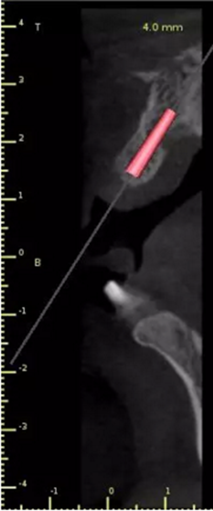 數(shù)字化修復(fù)病例分享 | 21單顆牙齒種植修復(fù) 數(shù)字化修復(fù)病例分享 | 21單顆牙齒種植修復(fù)