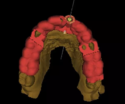 數(shù)字化修復(fù)病例分享 | 21單顆牙齒種植修復(fù) 數(shù)字化修復(fù)病例分享 | 21單顆牙齒種植修復(fù)