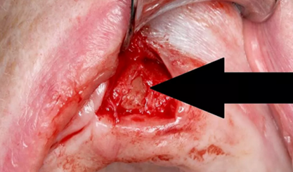 CARES?綜合的數(shù)字化解決方案---3D打印全程導(dǎo)板引導(dǎo)下植入病例一例 CARES?綜合的數(shù)字化解決方案---3D打印全程導(dǎo)板引導(dǎo)下植入病例一例