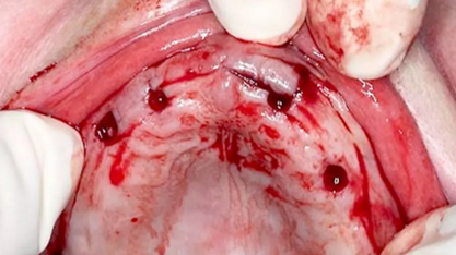 CARES?綜合的數(shù)字化解決方案---3D打印全程導(dǎo)板引導(dǎo)下植入病例一例 CARES?綜合的數(shù)字化解決方案---3D打印全程導(dǎo)板引導(dǎo)下植入病例一例