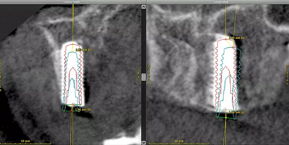CARES?綜合的數(shù)字化解決方案---3D打印全程導(dǎo)板引導(dǎo)下植入病例一例 CARES?綜合的數(shù)字化解決方案---3D打印全程導(dǎo)板引導(dǎo)下植入病例一例