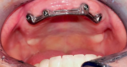 CARES?綜合的數(shù)字化解決方案---3D打印全程導(dǎo)板引導(dǎo)下植入病例一例 CARES?綜合的數(shù)字化解決方案---3D打印全程導(dǎo)板引導(dǎo)下植入病例一例