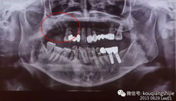拔牙窩的處理-新思路 拔牙窩的處理-新思路