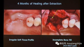 拔牙窩的處理-新思路 拔牙窩的處理-新思路