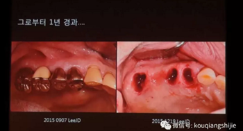 拔牙窩的處理-新思路 拔牙窩的處理-新思路