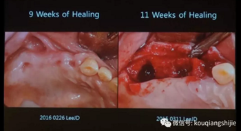 拔牙窩的處理-新思路 拔牙窩的處理-新思路