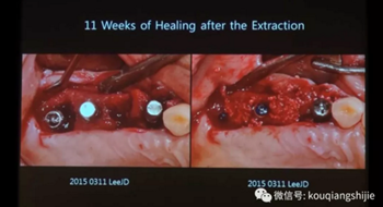 拔牙窩的處理-新思路 拔牙窩的處理-新思路