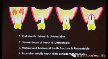 拔牙窩的處理-新思路 拔牙窩的處理-新思路